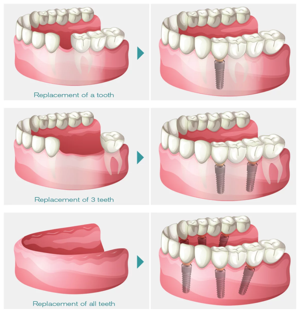 Cas-implant-dentaire_GB_saplings