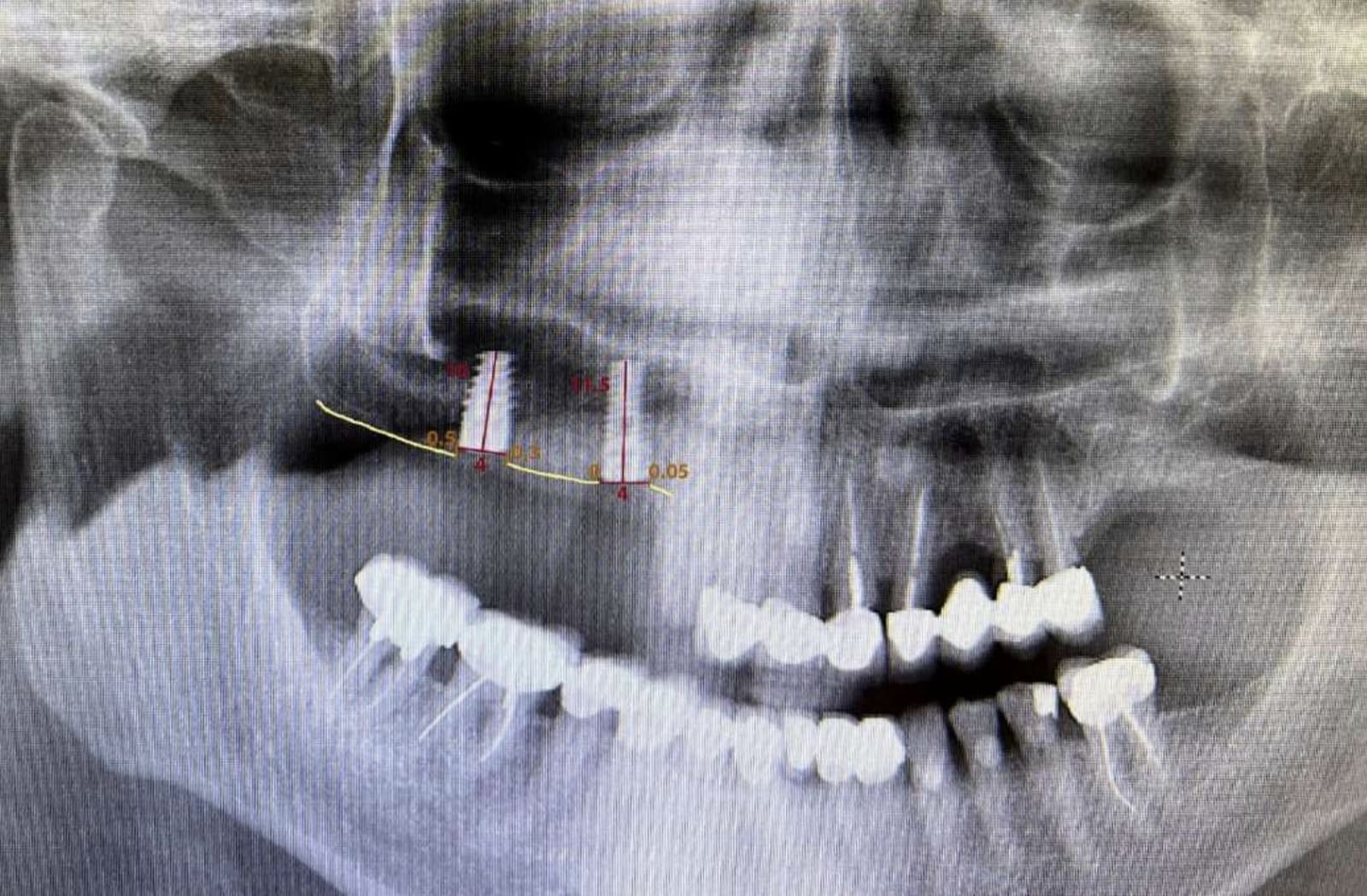 implant-dentaire-perte-osseuse-1-1